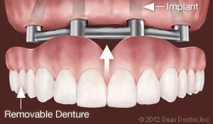 denture implants clovis ca