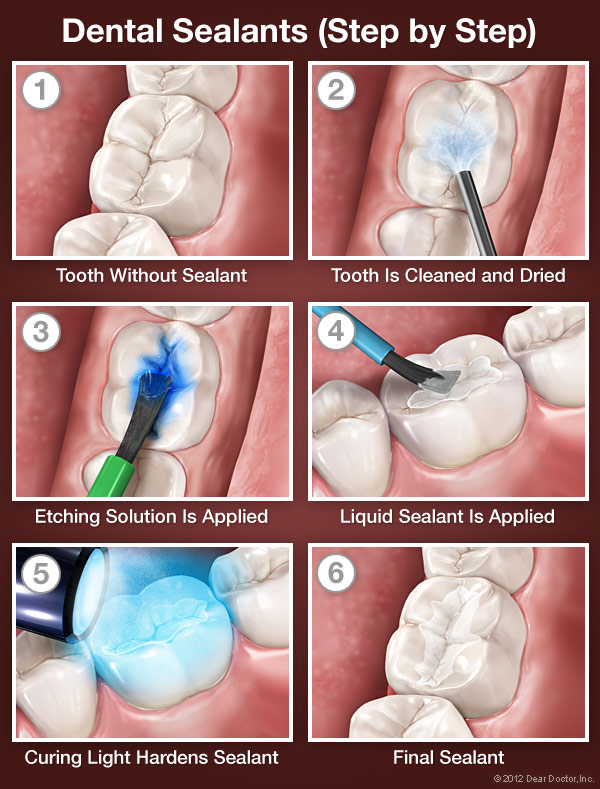 Dental Sealants | Spokane, WA | The Children's Choice