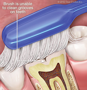 Toothbrush unable to clean grooves in teeth.