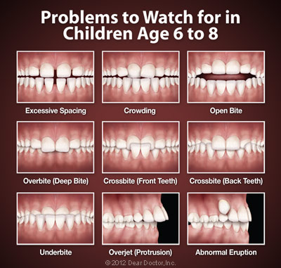 What Is a Palatal Expander and How Does it Work? - Precision