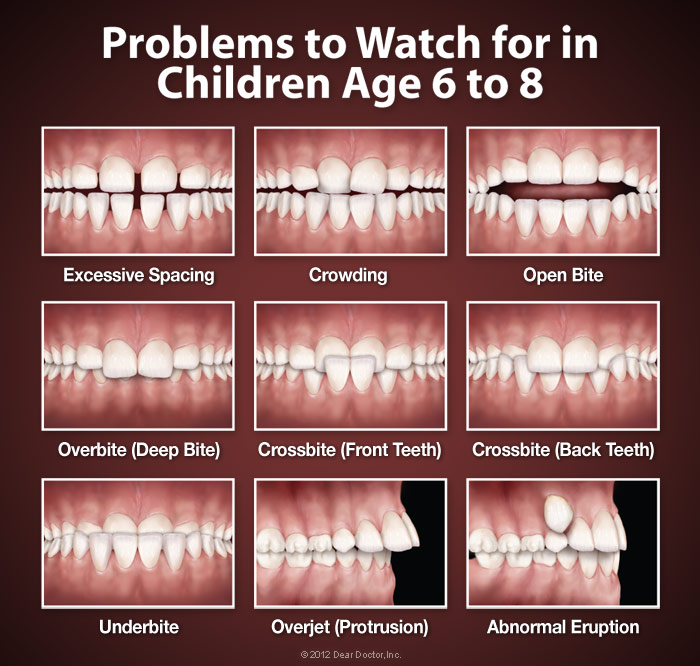 expanders for teeth age