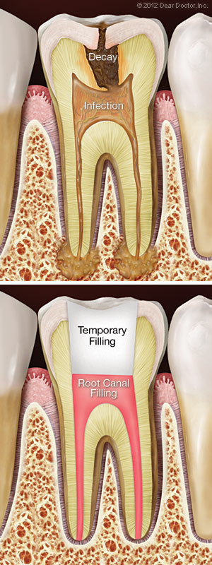 Image showing a decaying tooth in need of root canal treatment and a tooth after having been treated