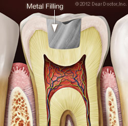 Metal Filling.