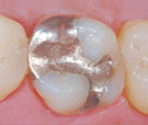 Metal Fillings.