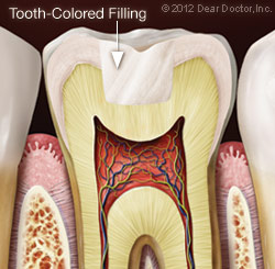 Tooth-Colored Filling.