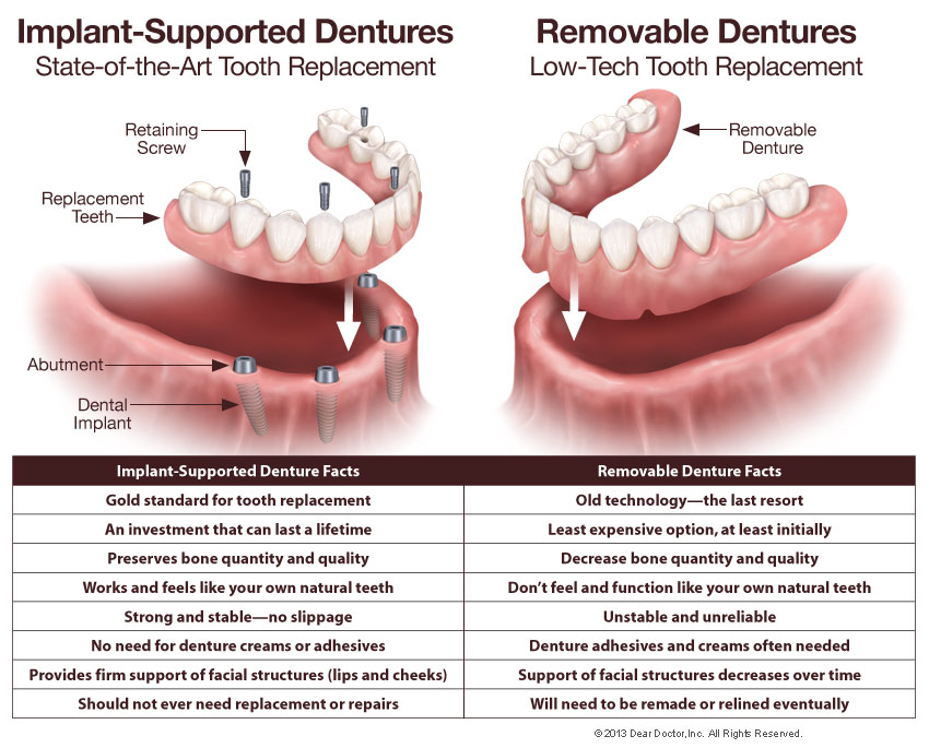 The Type Of Removable Prosthesis That Would Replace Teeth - Teeth Poster