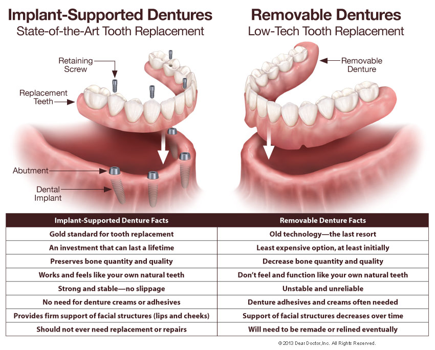 Hybrid denture vs overdenture