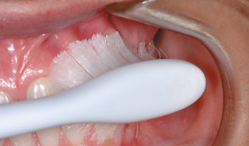 gum recession rogers dental center rogers mn gingival recession