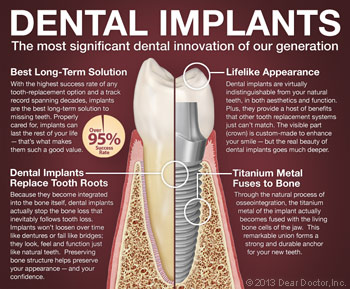 Dental Implants 101.