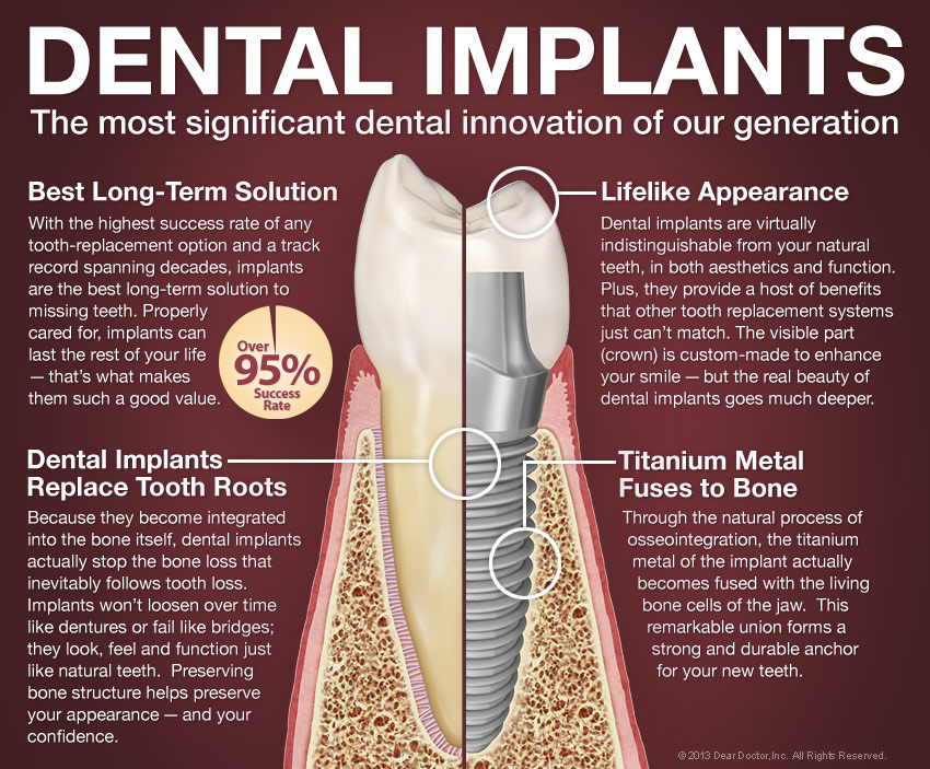 loose teeth and implants