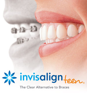 Braces The New Invisalign Teen 108