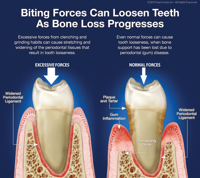 upper front teeth loose