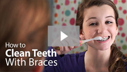 How to Clean Teeth With Braces