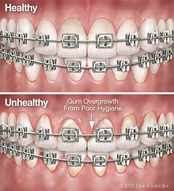 Cleaning Your Braces and Teeth Properly