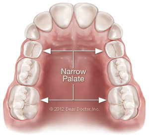 Narrow palate.