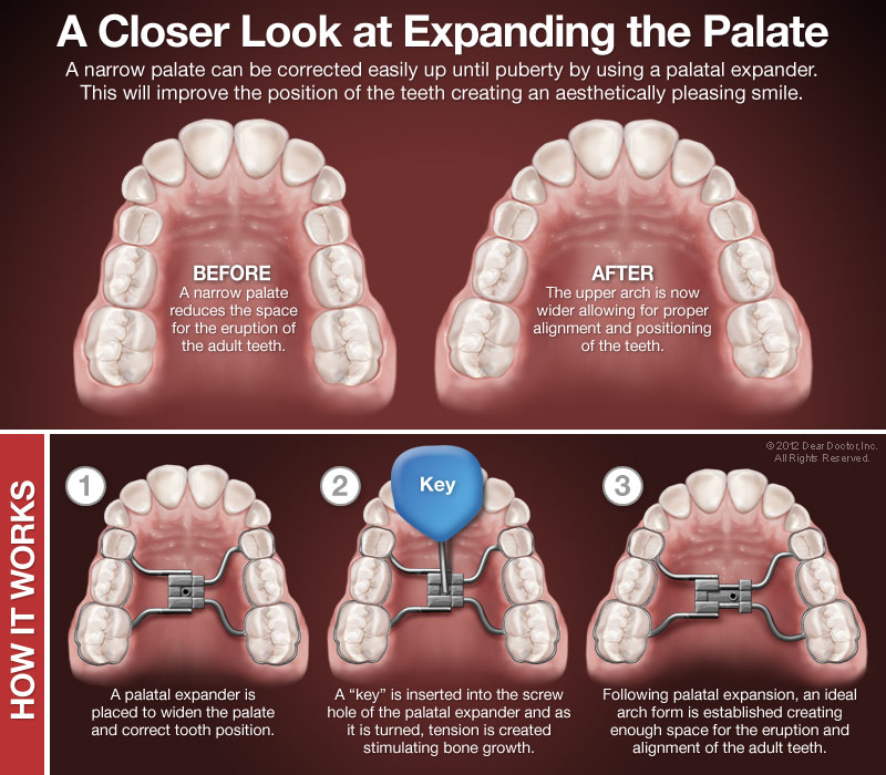 Palatal Expanders, Mission Hills & Blackhawk Center Orthodontics