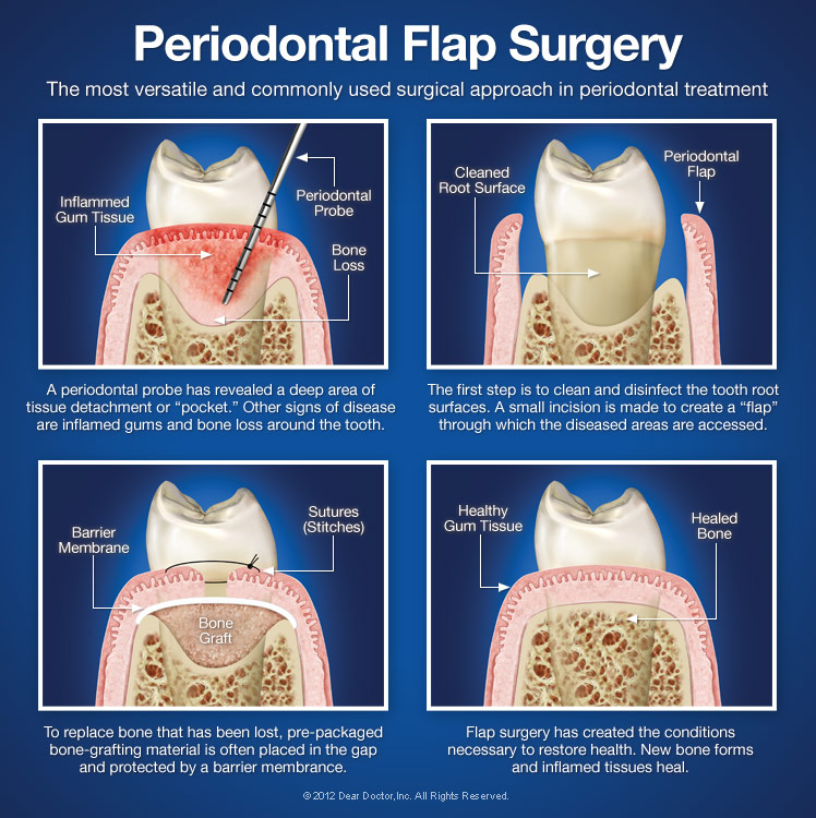 Periodontal Flap Surgery Stratford Orthodontics Stratford ON