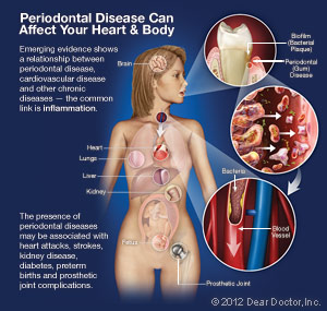 Periodontal Disease Can Affect Your Heart and Body