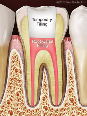 Tooth after root canal treatment.