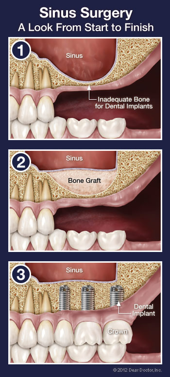 sinus complications after wisdom teeth extraction