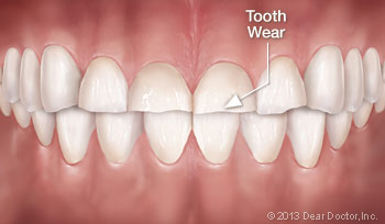 effects teeth grinding