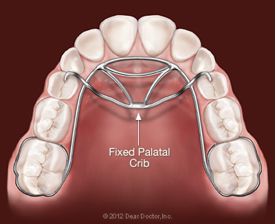 Fixed palatal crib.