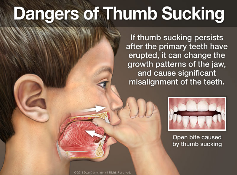 sucking orthodonture thumb