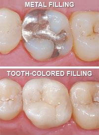 Tooth Colored Fillings