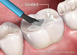 Dental sealants.