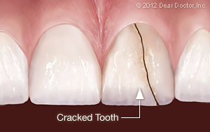 Cracked tooth.