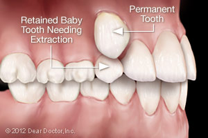 Retained baby tooth needing extraction.