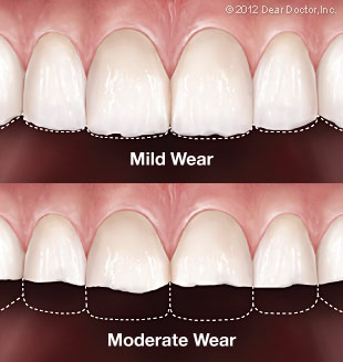 grinding teeth enamel loss