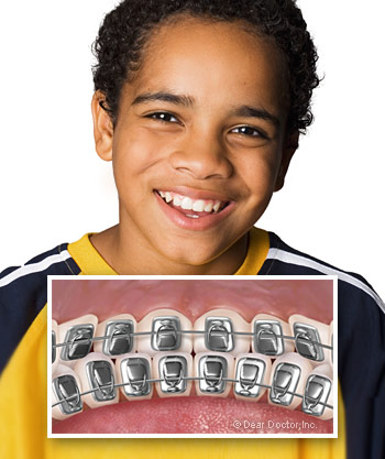 Braces Provide a Range of Options for Patients of All Ages