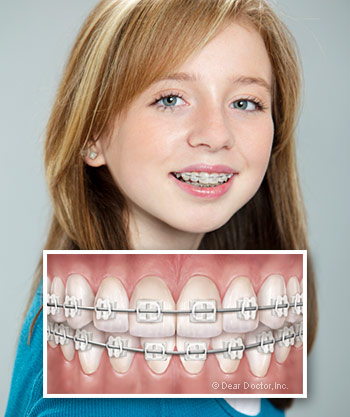 Ceramic Braces vs. Metal Braces: Nikaeen Orthoodontic