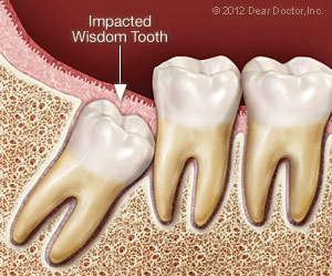 recovery period for wisdom teeth surgery