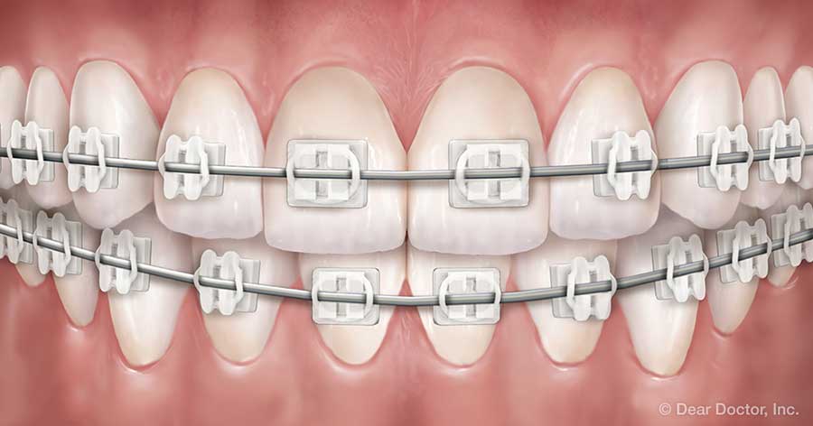 Clear Braces. Clear Braces.