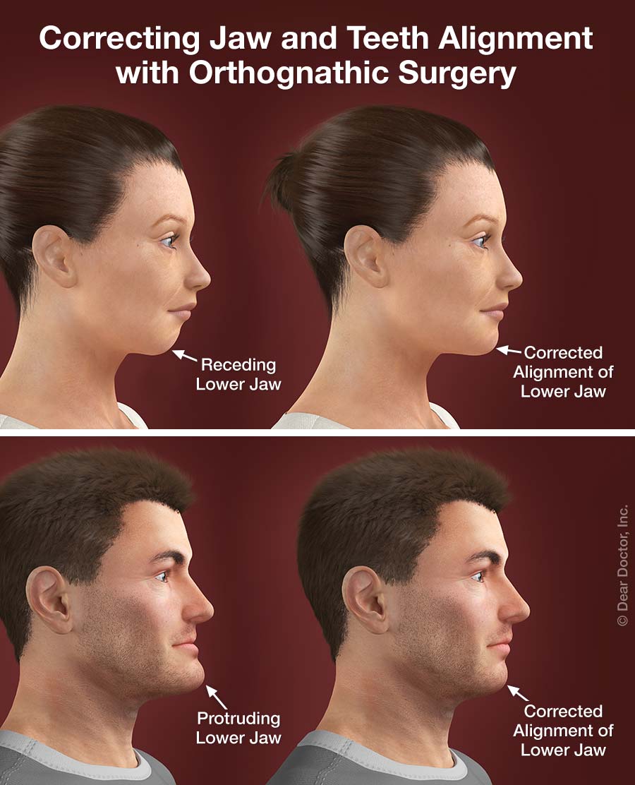 Corrective Jaw (Orthognathic) Surgery.