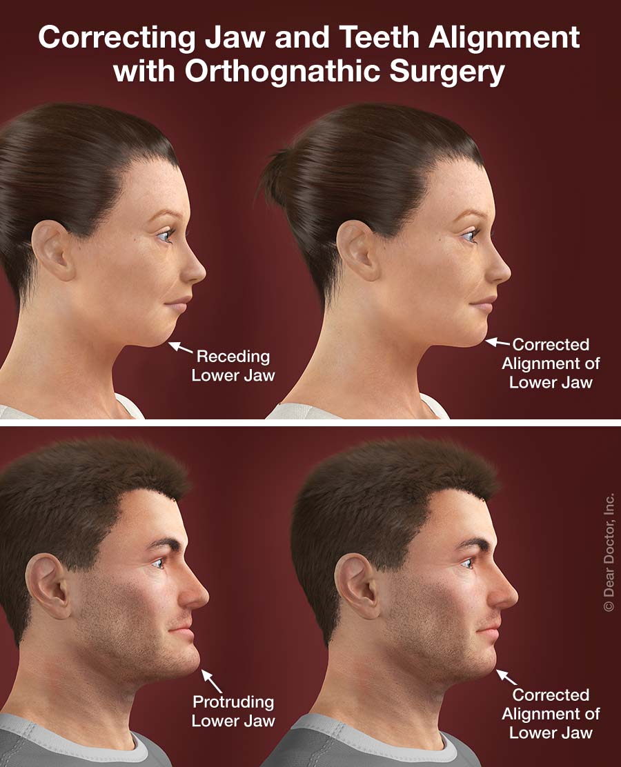 Corrective (Jaw) Surgery, Mary E. Burns D.M.D.