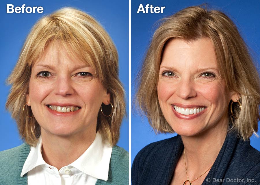 Before and After Cosmetic Dentistry.