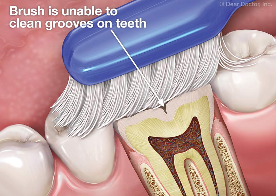 Dental Sealants