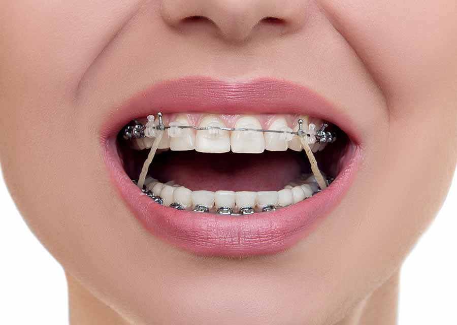 Elastics in orthodontic treatment.