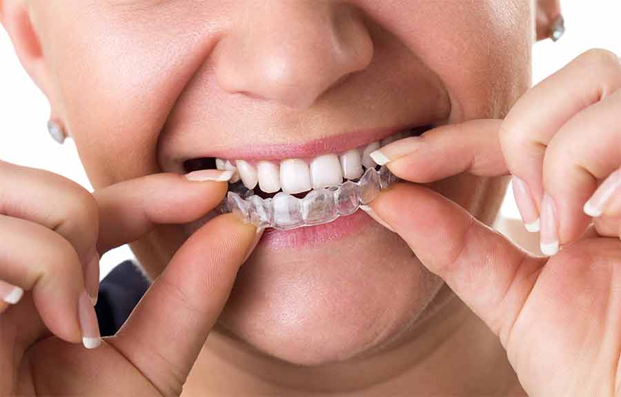 Teen with an Invisalign aligner