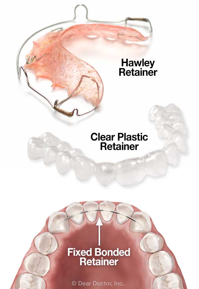 Types of orthodontic retainers.