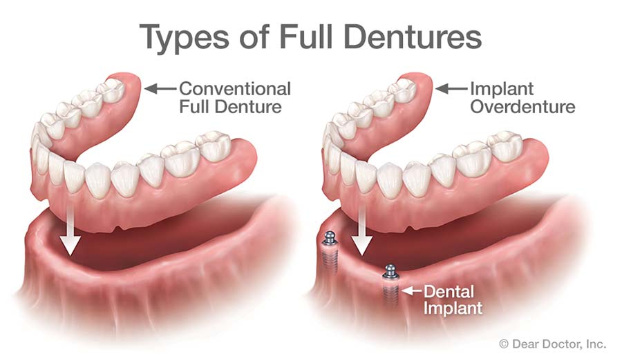 Removable Dentures | Saddle Brook Dental Care