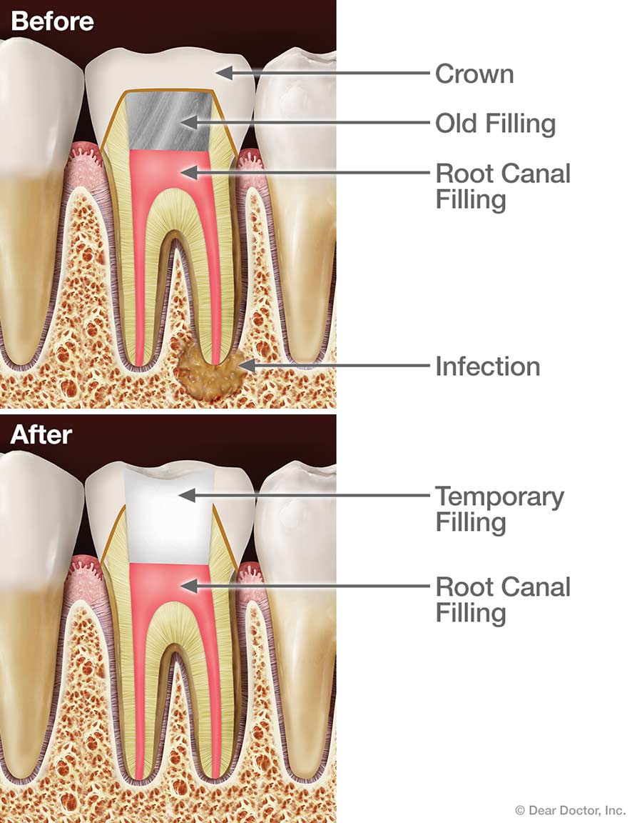 root-canal-retreatment