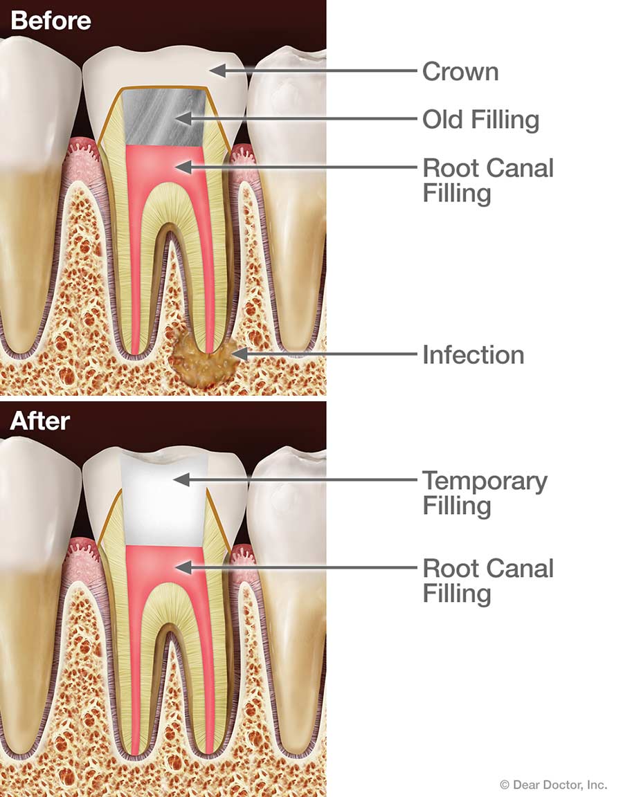 cracked root canal filling