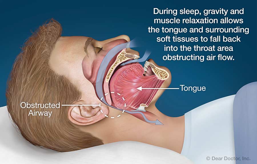Obstructive Sleep Apnea.