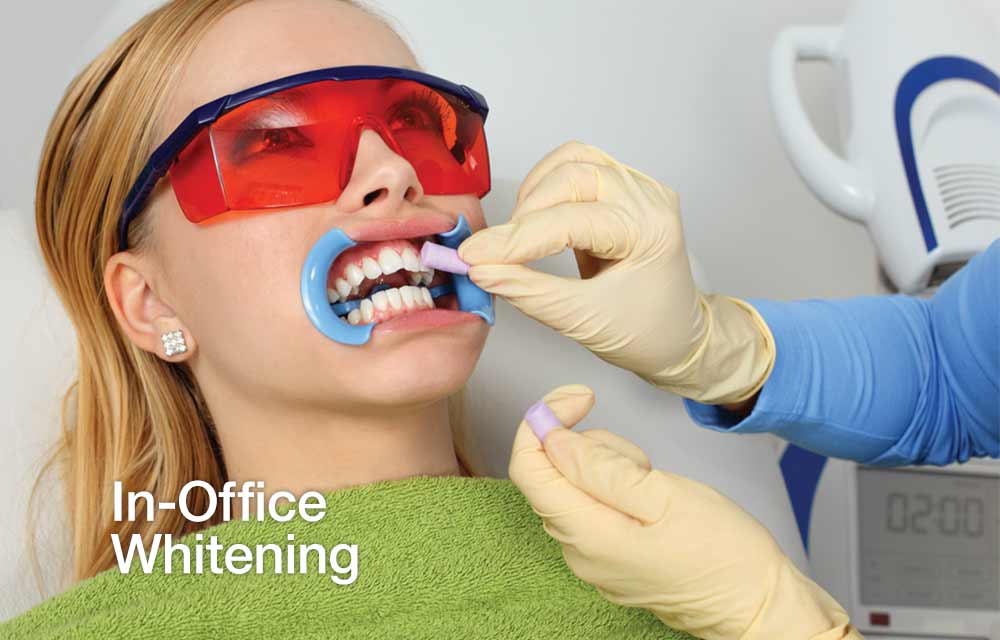 In-Office Teeth Whitening.