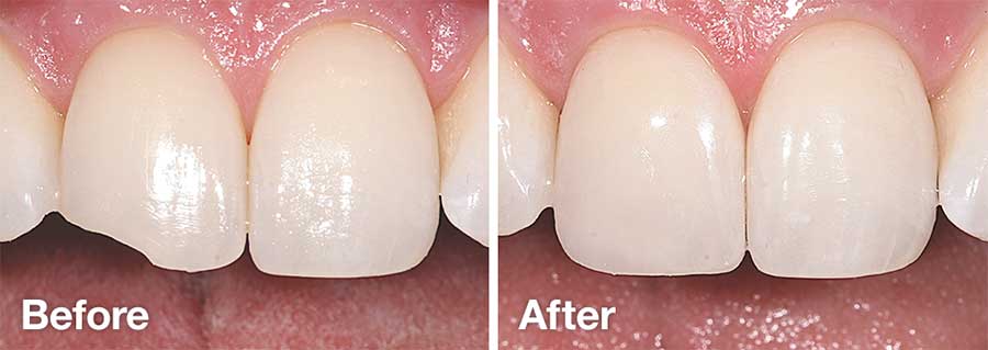 Before and After Tooth Bonding.