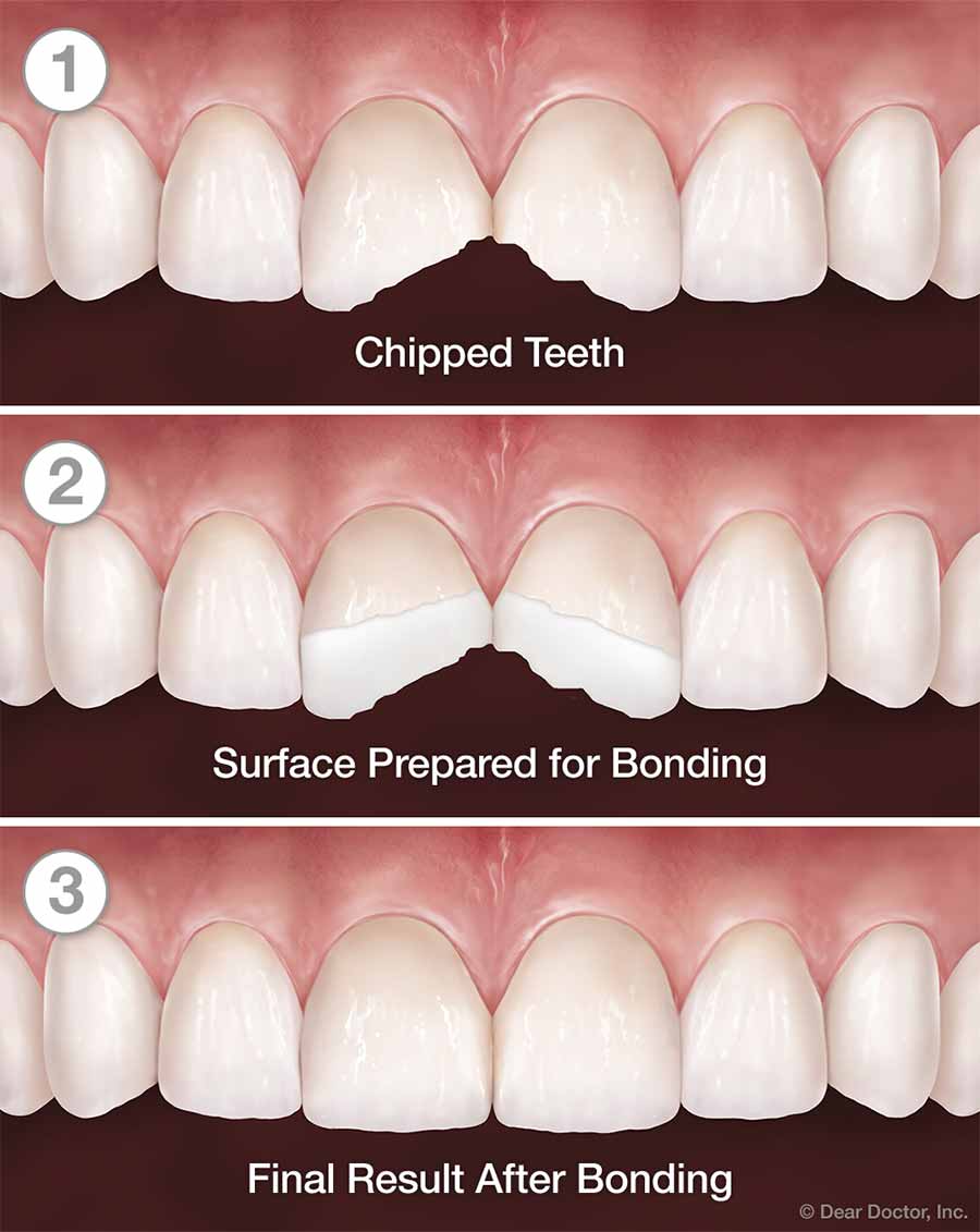 Tooth Bonding - Step by Step.